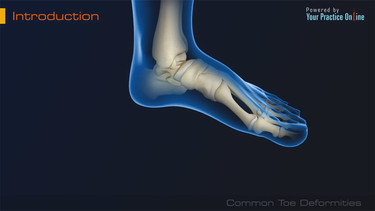 Toe Deformities Video Toe Surgery Arthritis