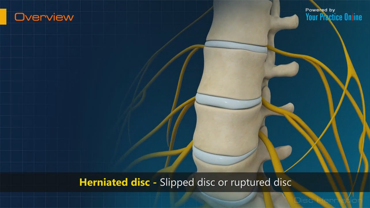 Herniated Disc Video | Slipped Disc Treatment Video | Pinched Nerve Video Herniated Disc Video | Slipped Disc Treatment Video | Pinched Nerve Video