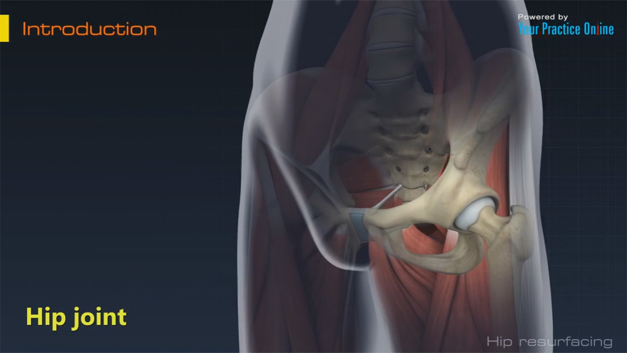 Hip Resurfacing Video | Hip Surgery Videos | Your Practice Online Education