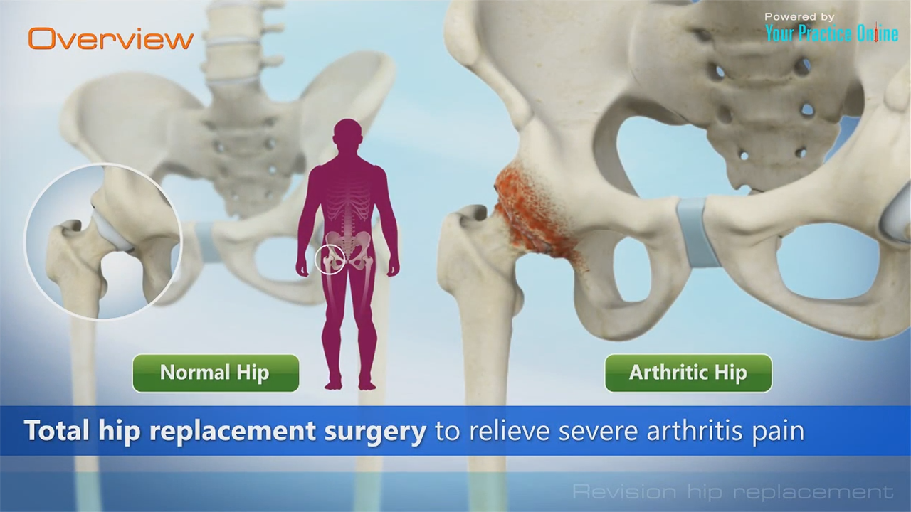 Total Hip Replacement Surgery Video