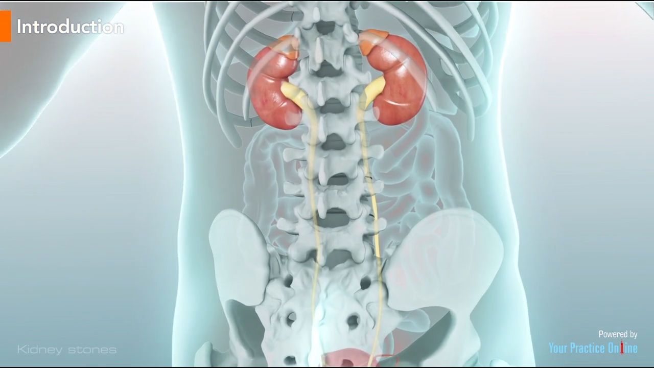 Kidney Stones Video | Genitourinary Videos | Patient Education Library