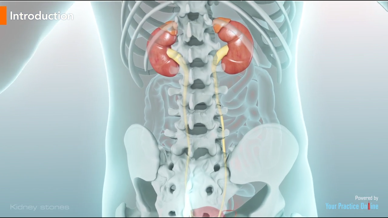 Kidney Stones Video | Genitourinary Videos | Patient Education Library Kidney Stones Video | Genitourinary Videos | Patient Education Library