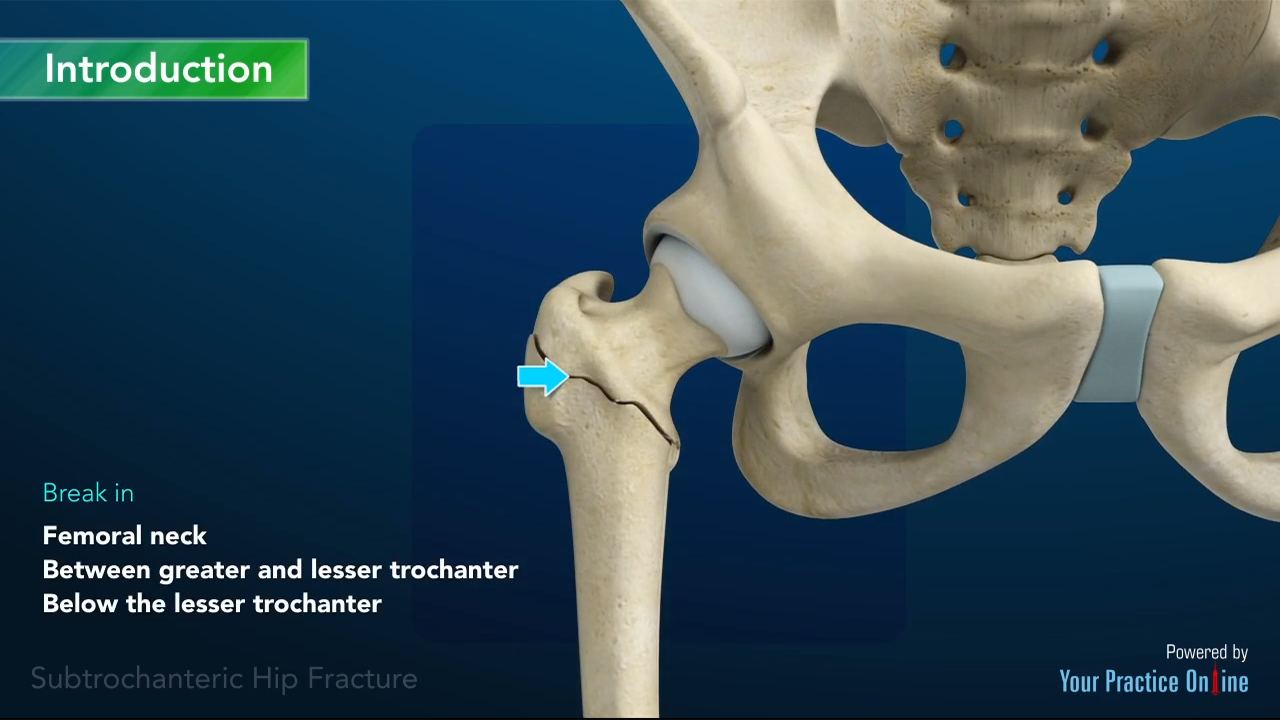 Subtrochanteric Hip fracture Video | Medical Video Library