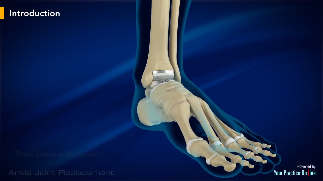 Video On Ankle Joint Replacement Ankle Arthroplasty Surgery
