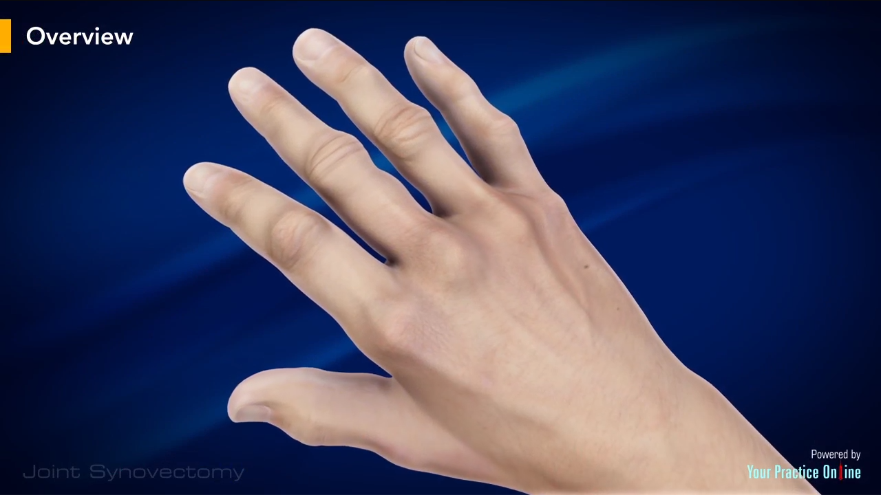 Joint Synovectomy Video Medical Video Library
