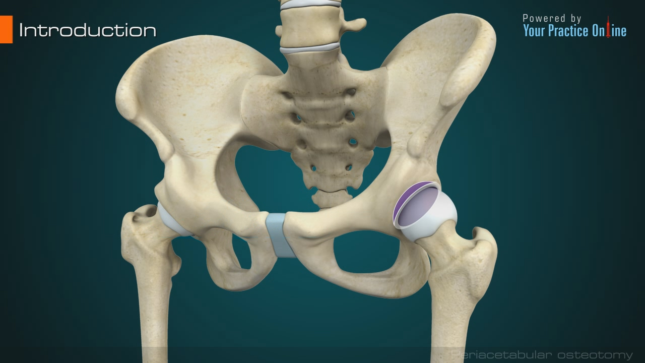 Periacetabular Osteotomy Video | Medical Video Library