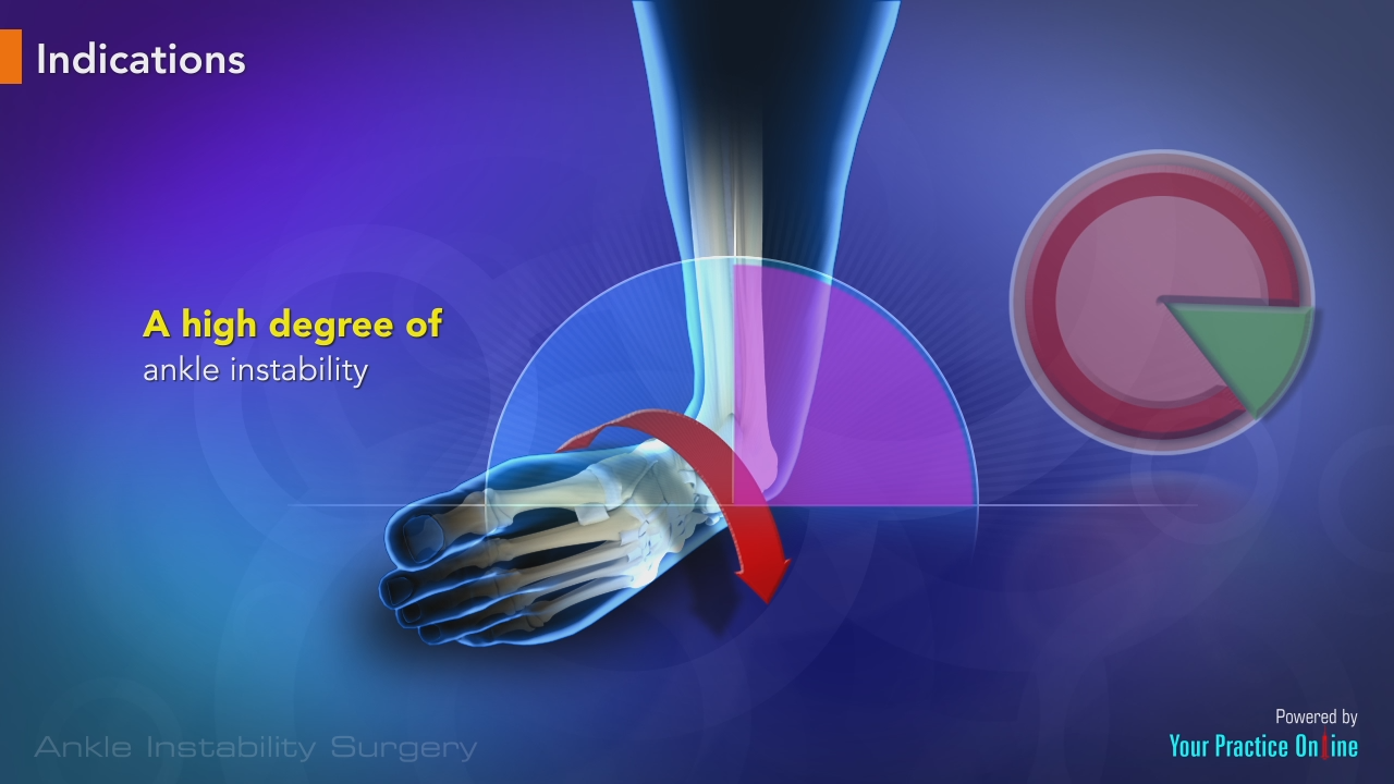 Ankle Instability Surgery video thumbnail
