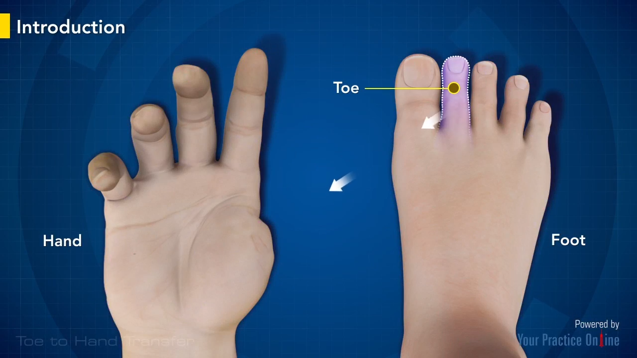 Toe to Hand Transfer Video | Medical Video Library