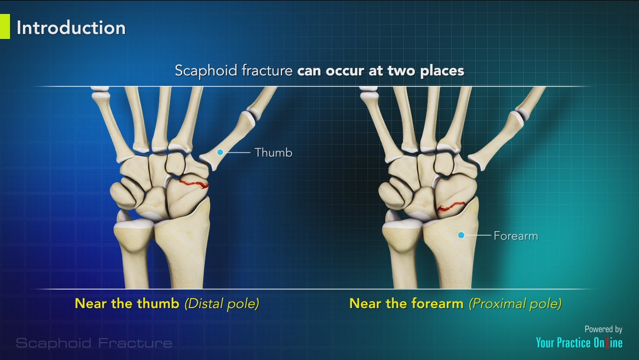 Scaphoid Fracture Video Medical Video Library