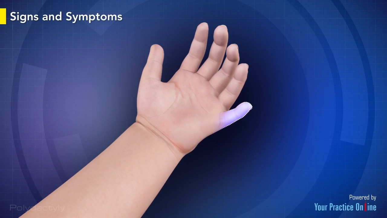 Polydactyly Video | Medical Video Library