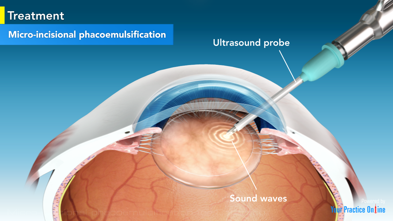 Операция факоэмульсификация катаракты