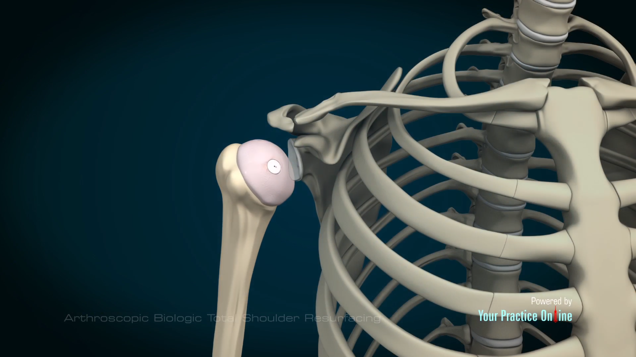 Arthroscopic Biologic Total Shoulder Resurfacing Video | Medical Video Library