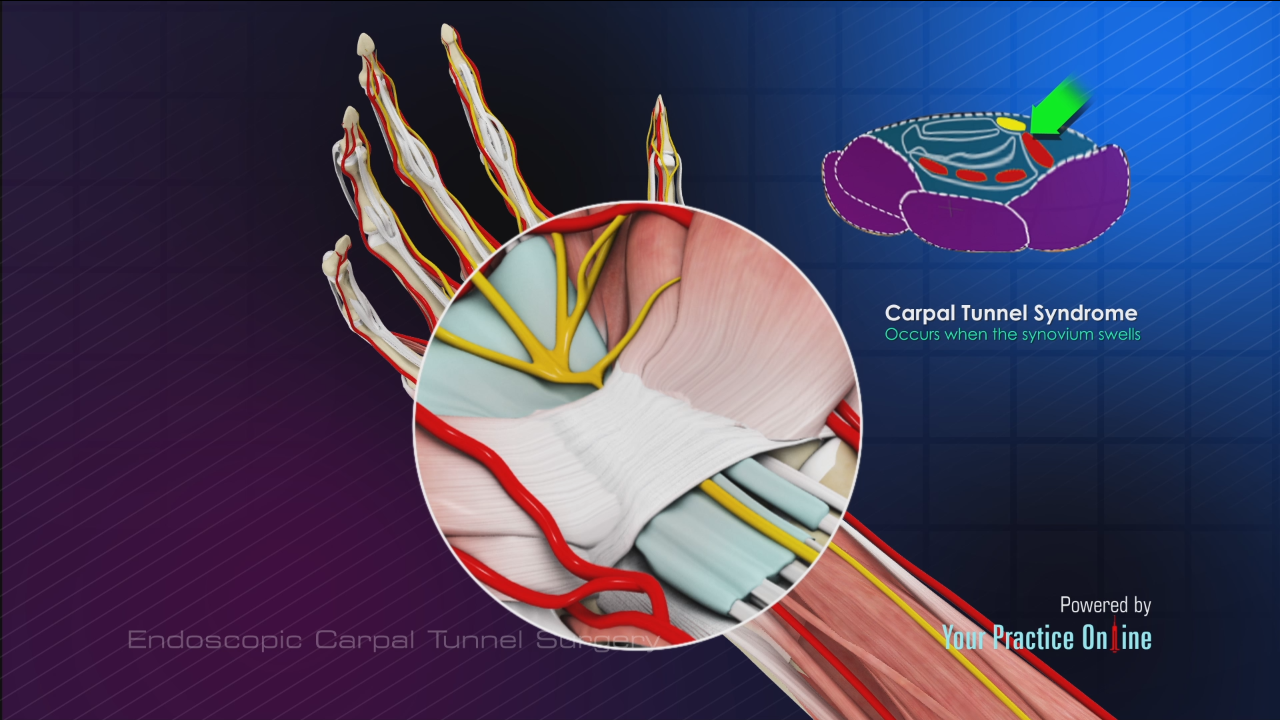 Double Incision Endoscopic Carpal Tunnel Surgery Video | Medical Video ...