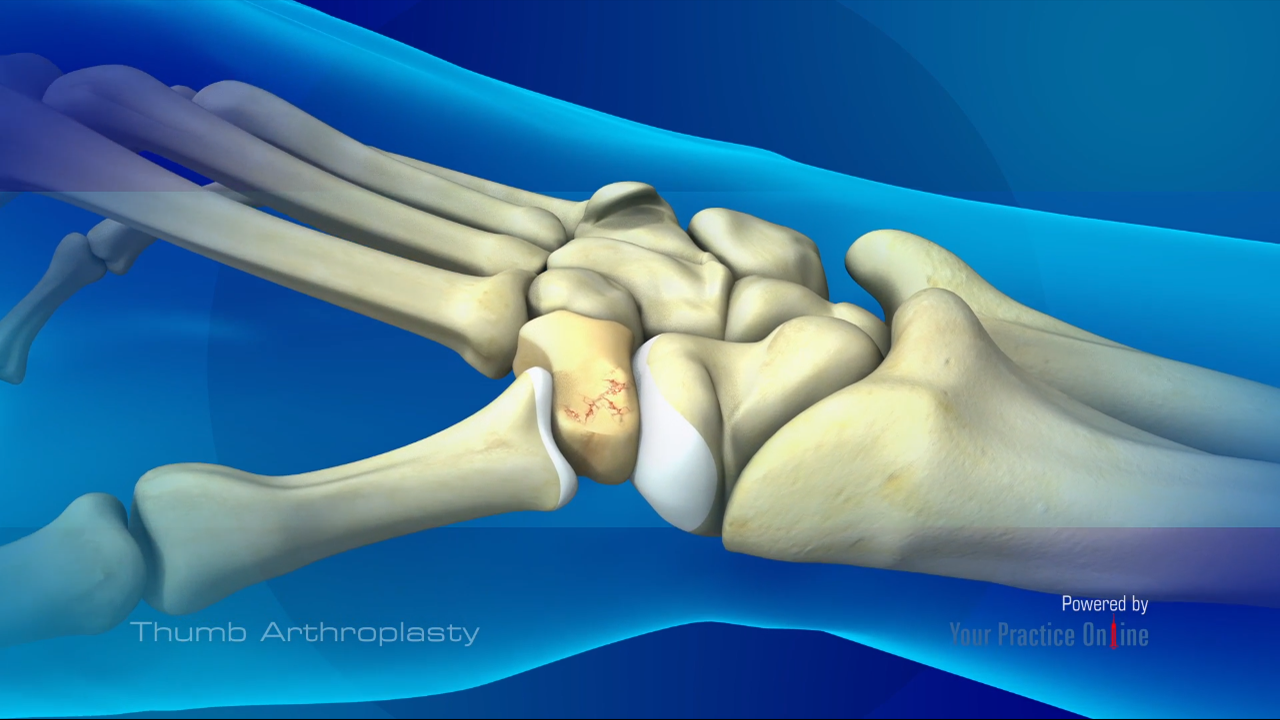 Thumb Arthroplasty Video | Medical Video Library