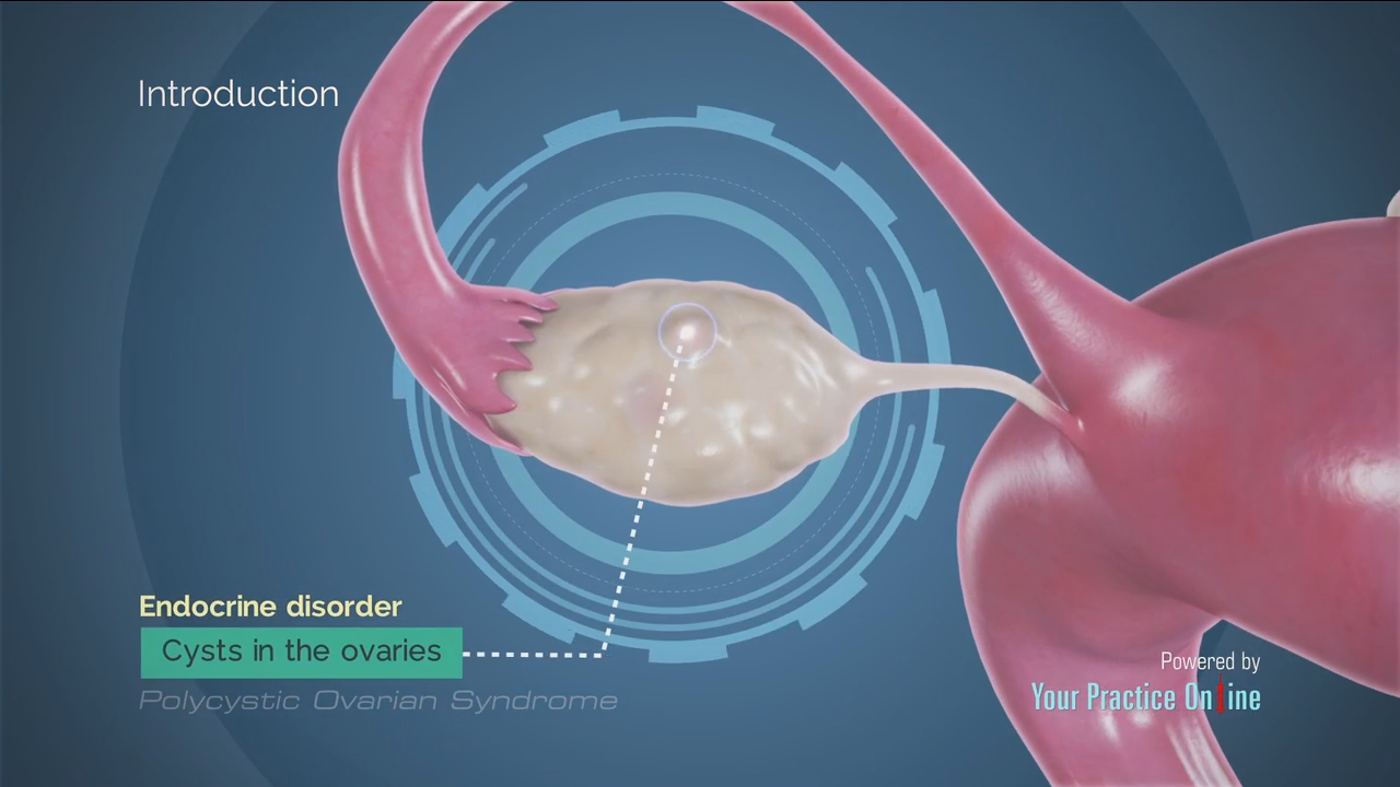 Polycystic Ovarian Syndrome Video | Medical Video Library