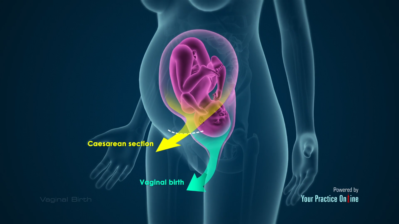 Vaginal Birth Video | Medical Video Library Vaginal Birth Video | Medical Video Library
