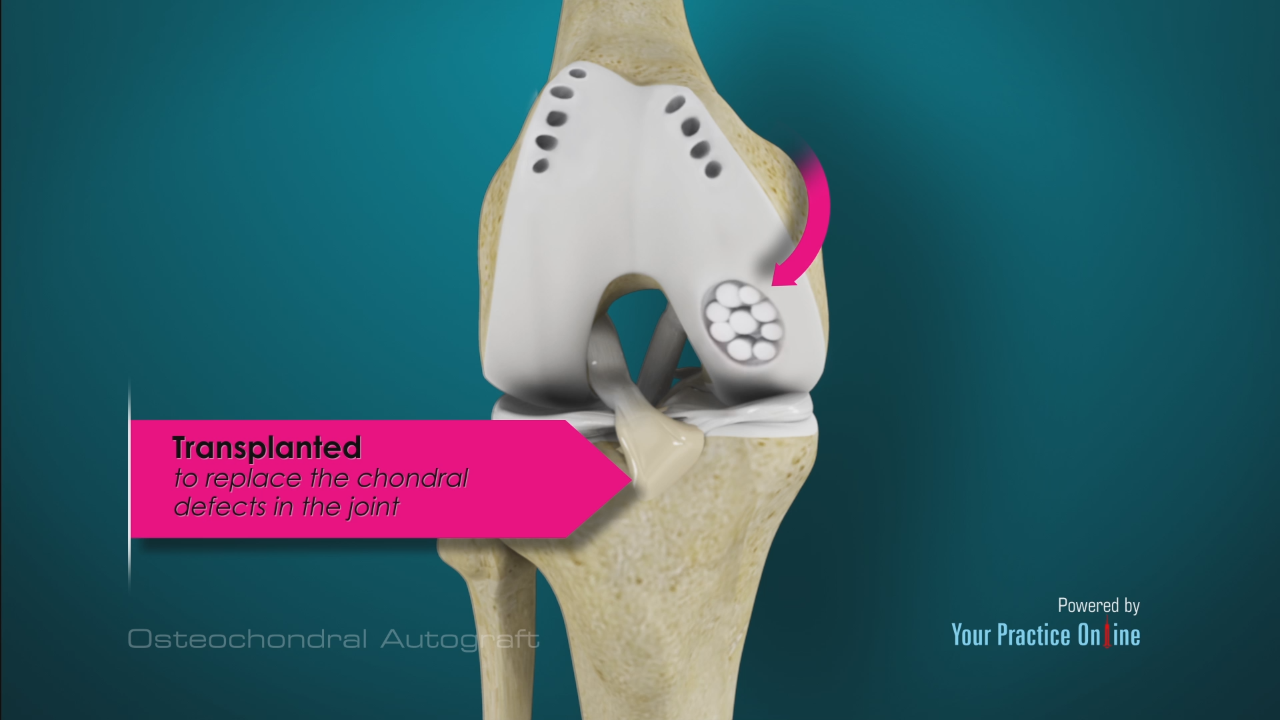 Osteochondral Autograft Video | Cartilage Autograft Surgery Video