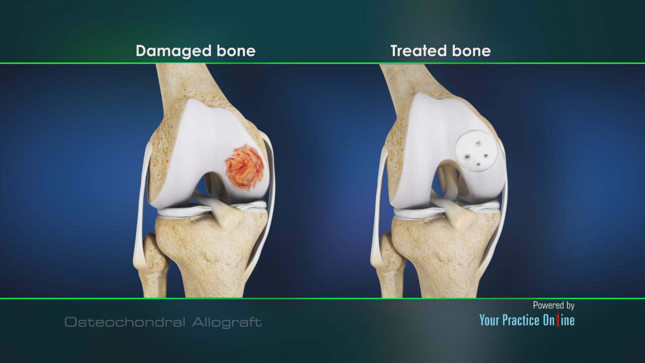 osteochondral allograft cartilage