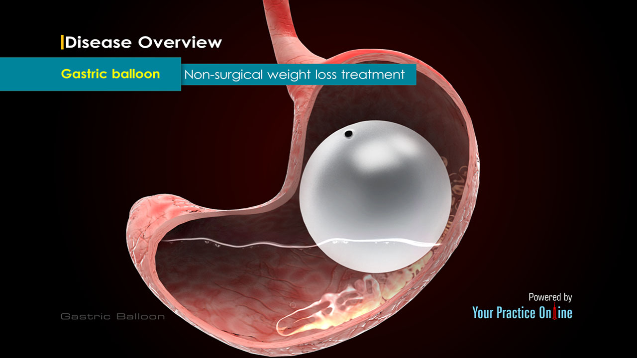 Gastric Balloon Surgery Weight