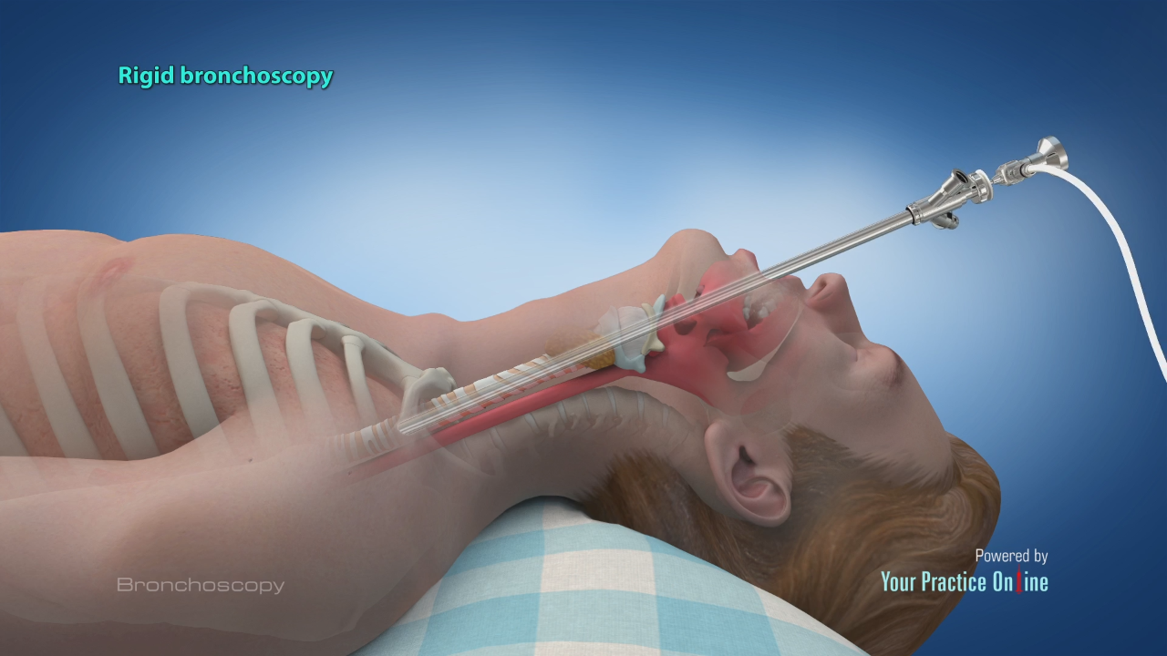 Bronchoscopy Procedure Video | What is Bronchoscopy | Lungs & Lymph Nodes  Scan