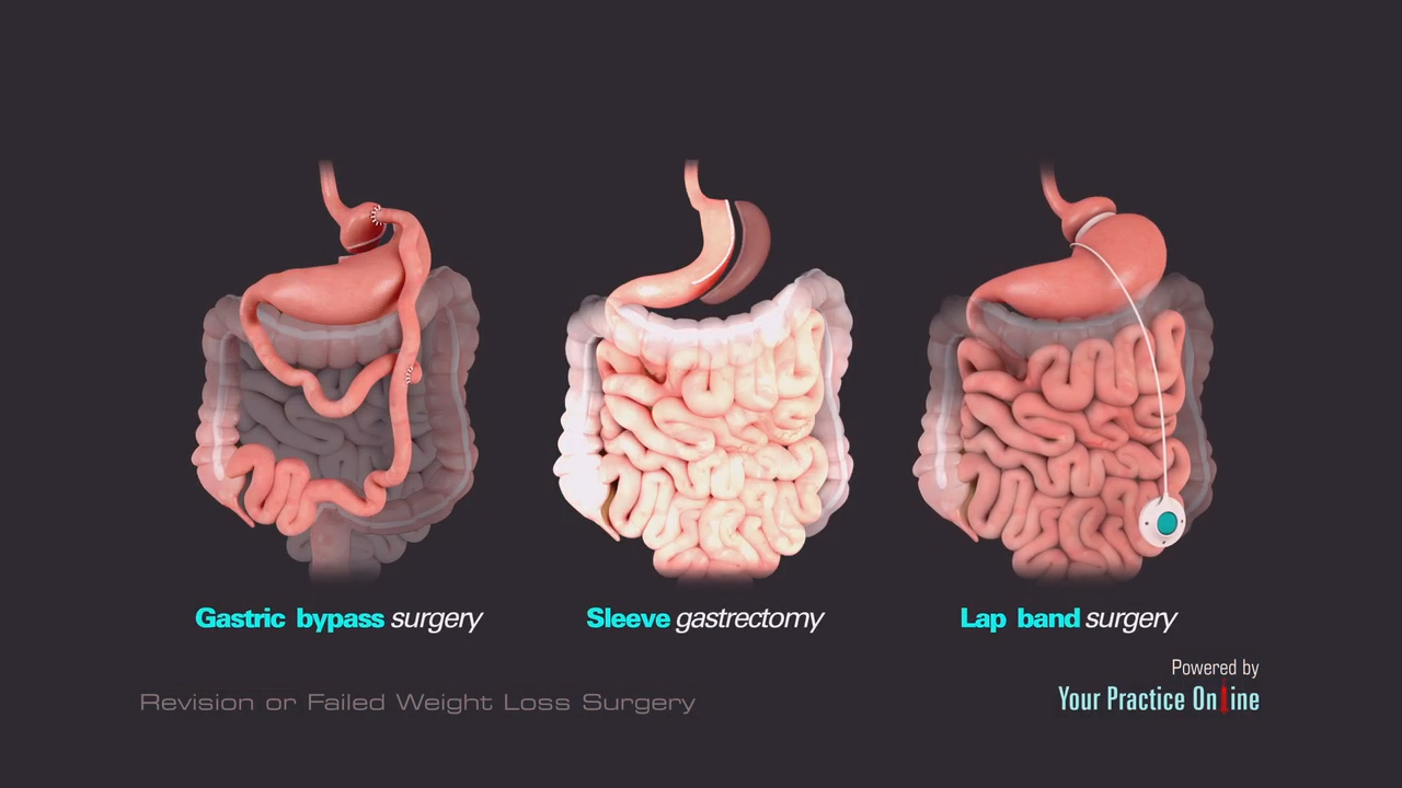 Revision or Failed Weight Loss Surgery Video | Medical Video Library