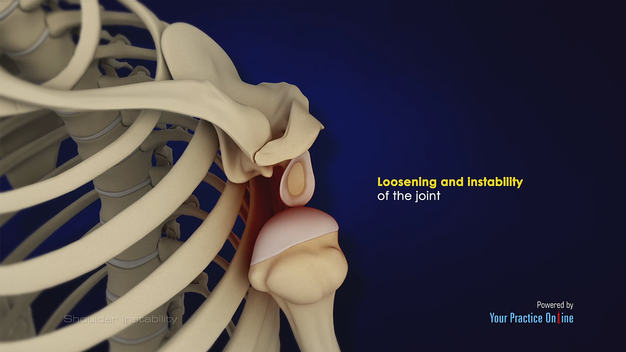 Shoulder Instability Video Medical Video Library