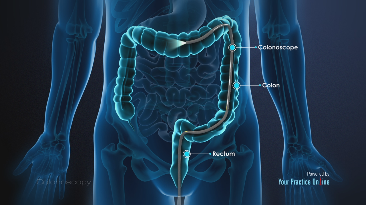 Colonoscopy Video Medical Video Library
