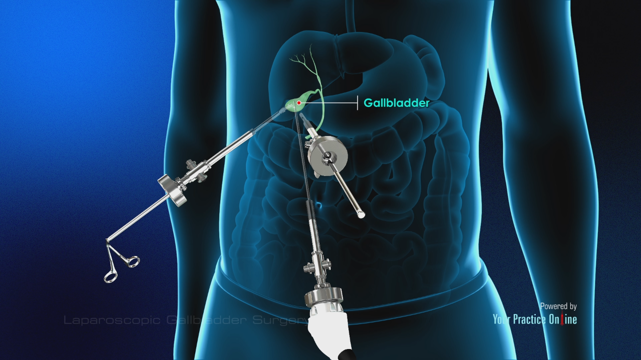 Gallbladder Removal Before And After