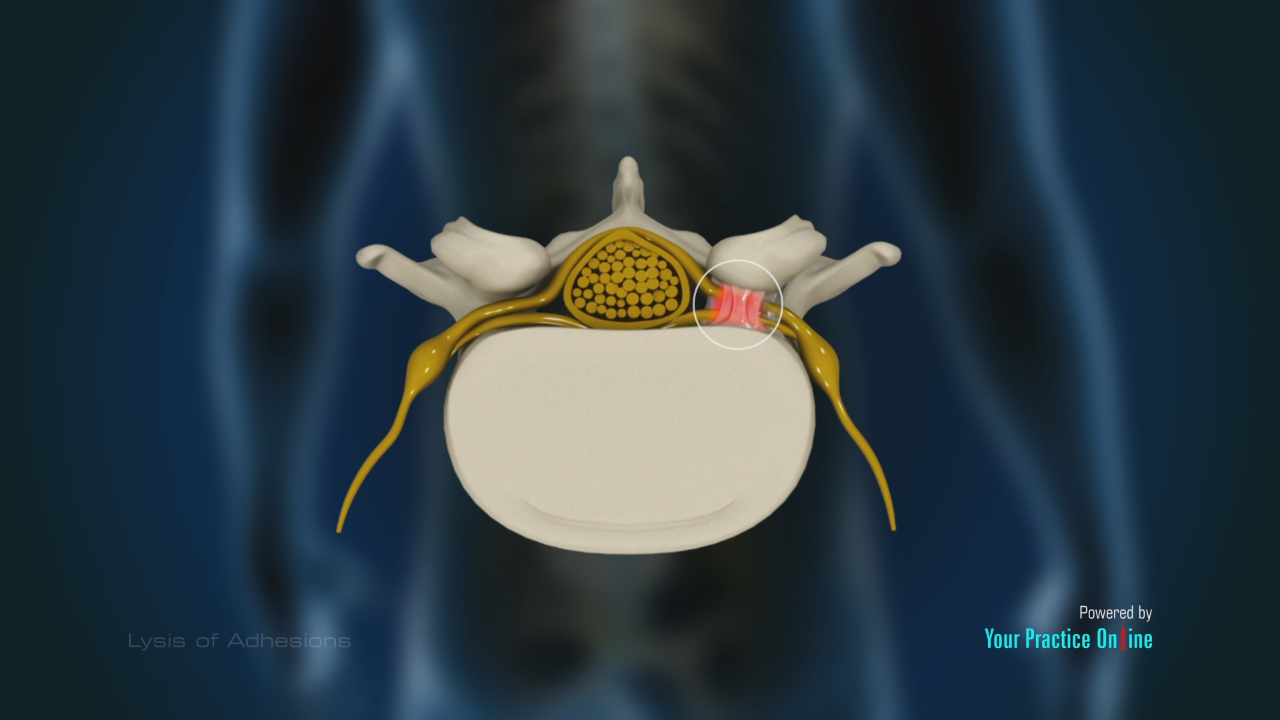 Lysis of Adhesions Video | Medical Video Library