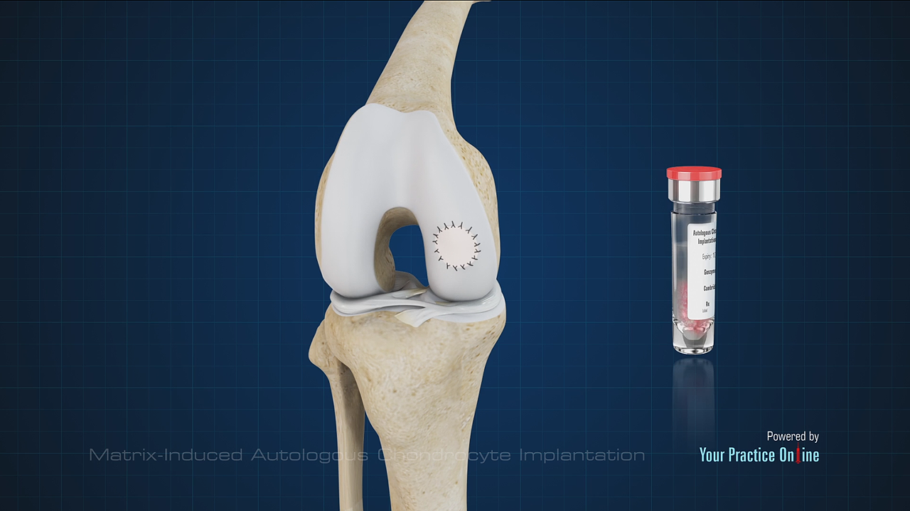 Matrix-Induced Autologous Chondrocyte Implantation Video | Medical Video Library