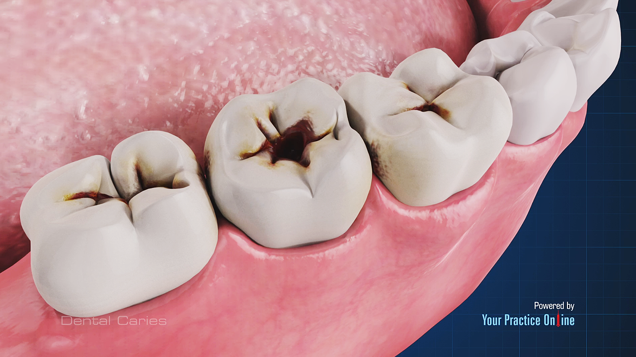 dental caries progression