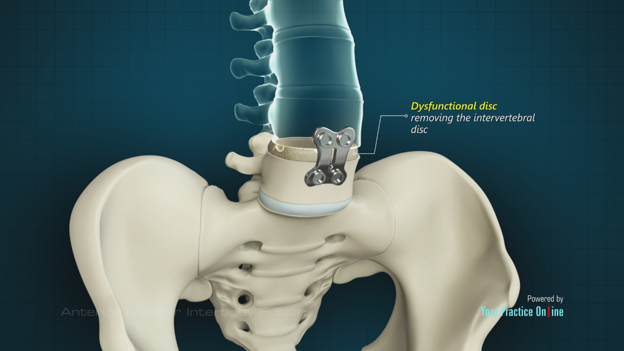 Anterior Lumbar Interbody Fusion Video | Medical Video Library