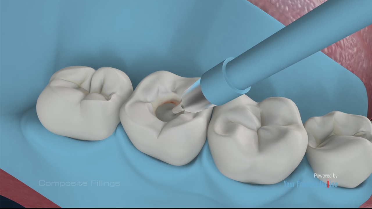 Composite Fillings Video | Medical Video Library
