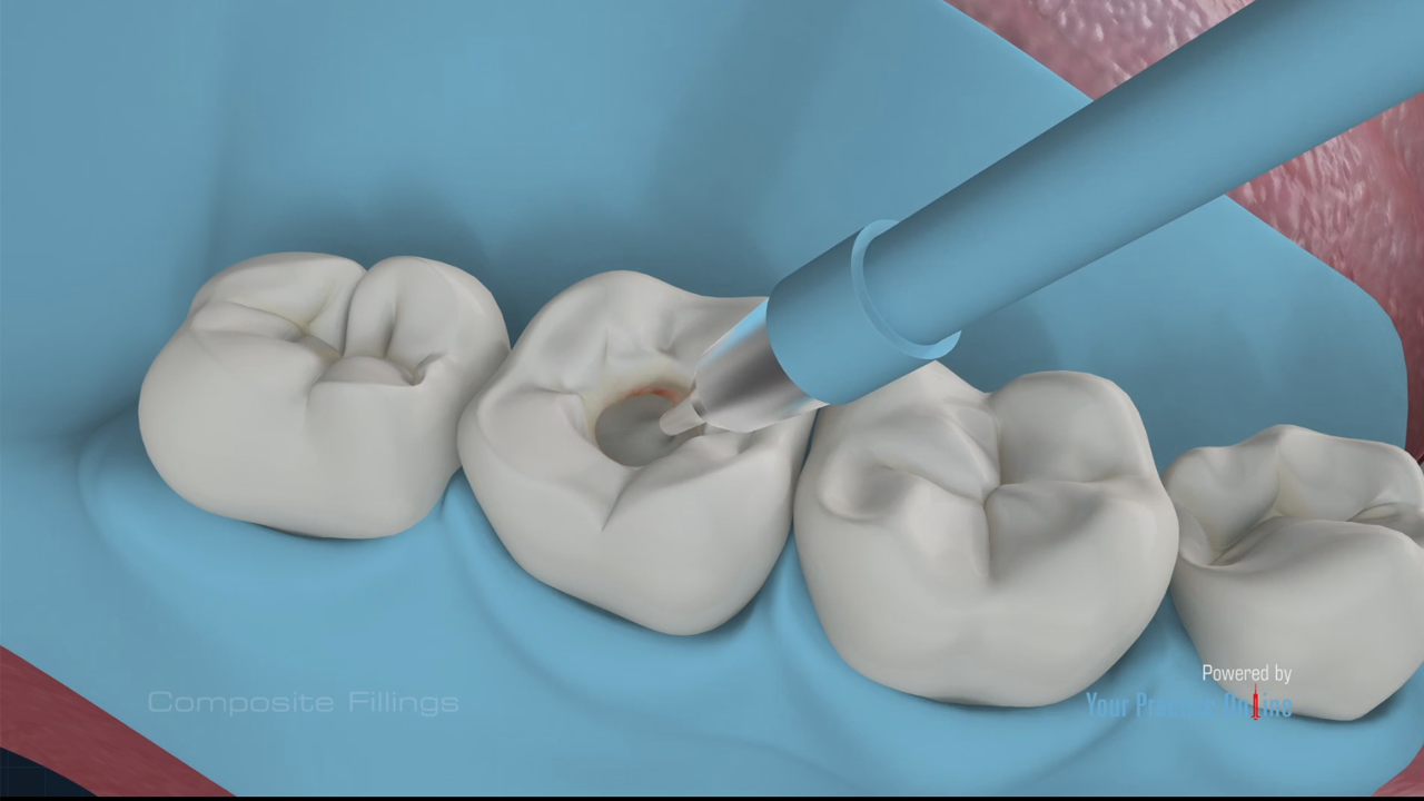 Composite Fillings Video | Medical Video Library Composite Fillings Video | Medical Video Library