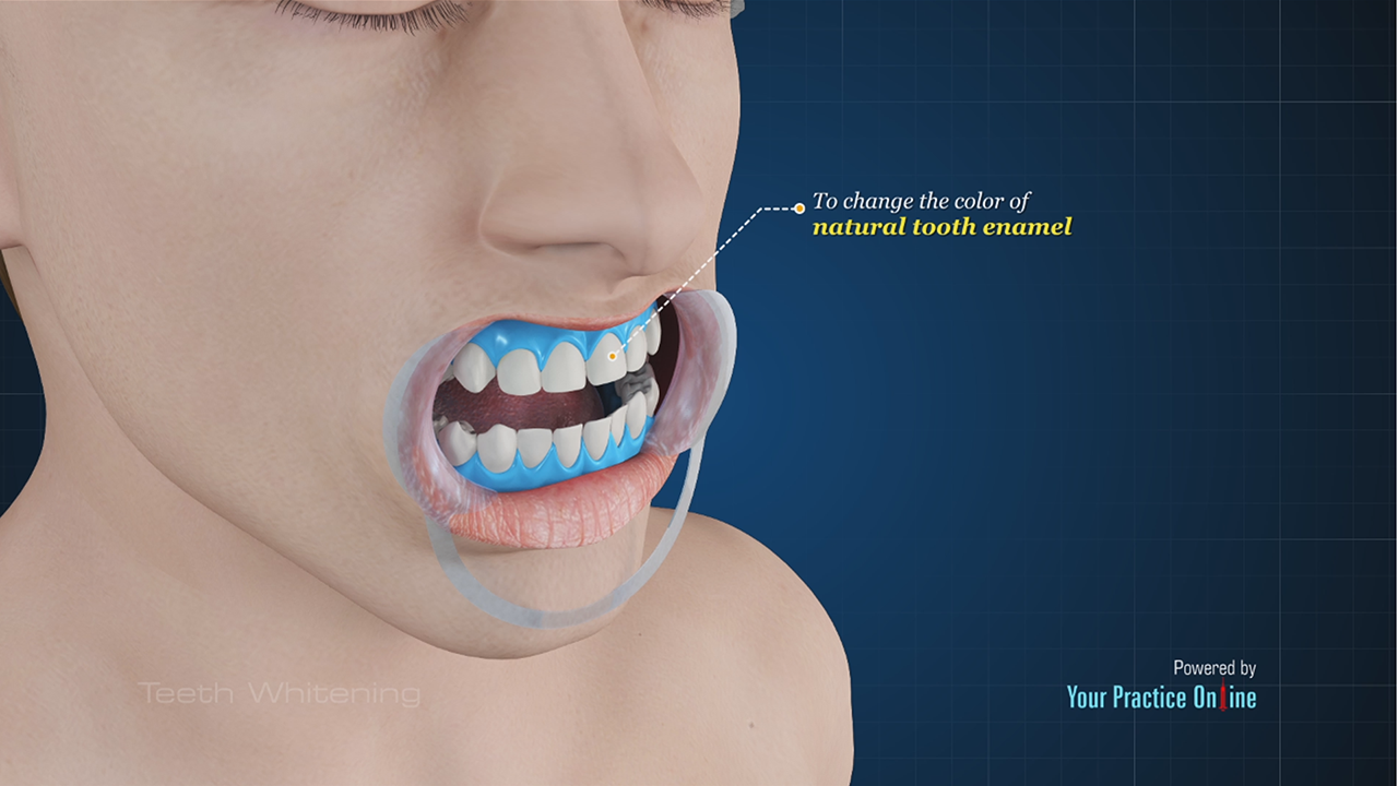 Teeth Whitening Video | Medical Video Library