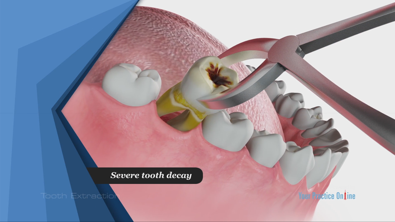 How To Pull A Broken Wisdom Tooth At Home