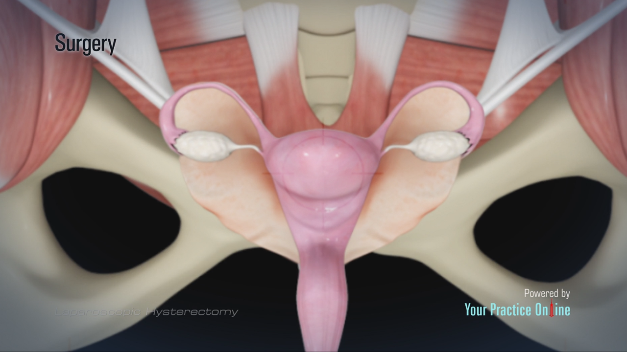 laparoscopic hysterectomy before and after