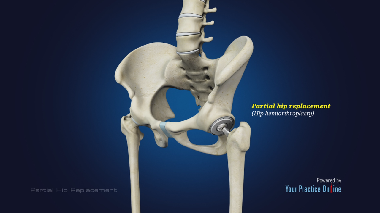 Partial Hip Replacement Video