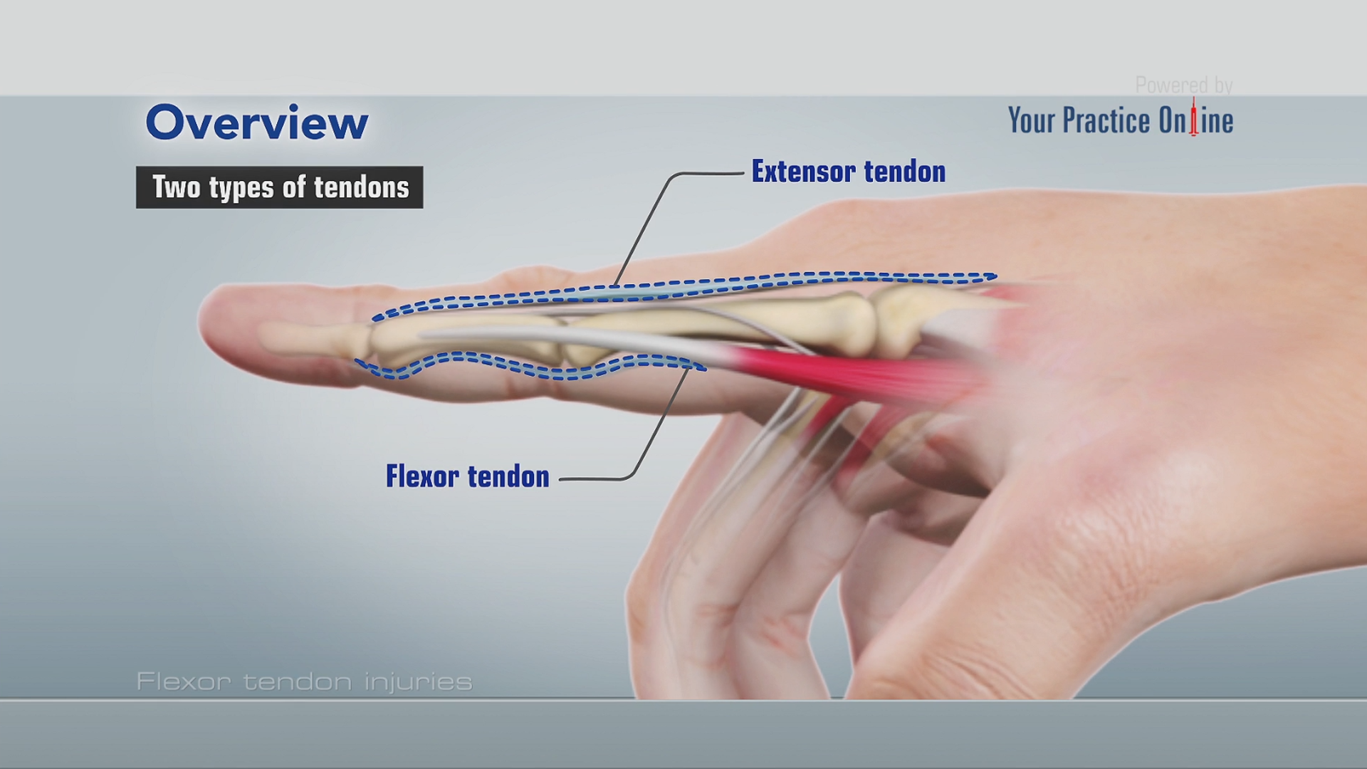 Tendon Diagram / Tennis Elbow Lateral Epicondylitis Orthoinfo Aaos