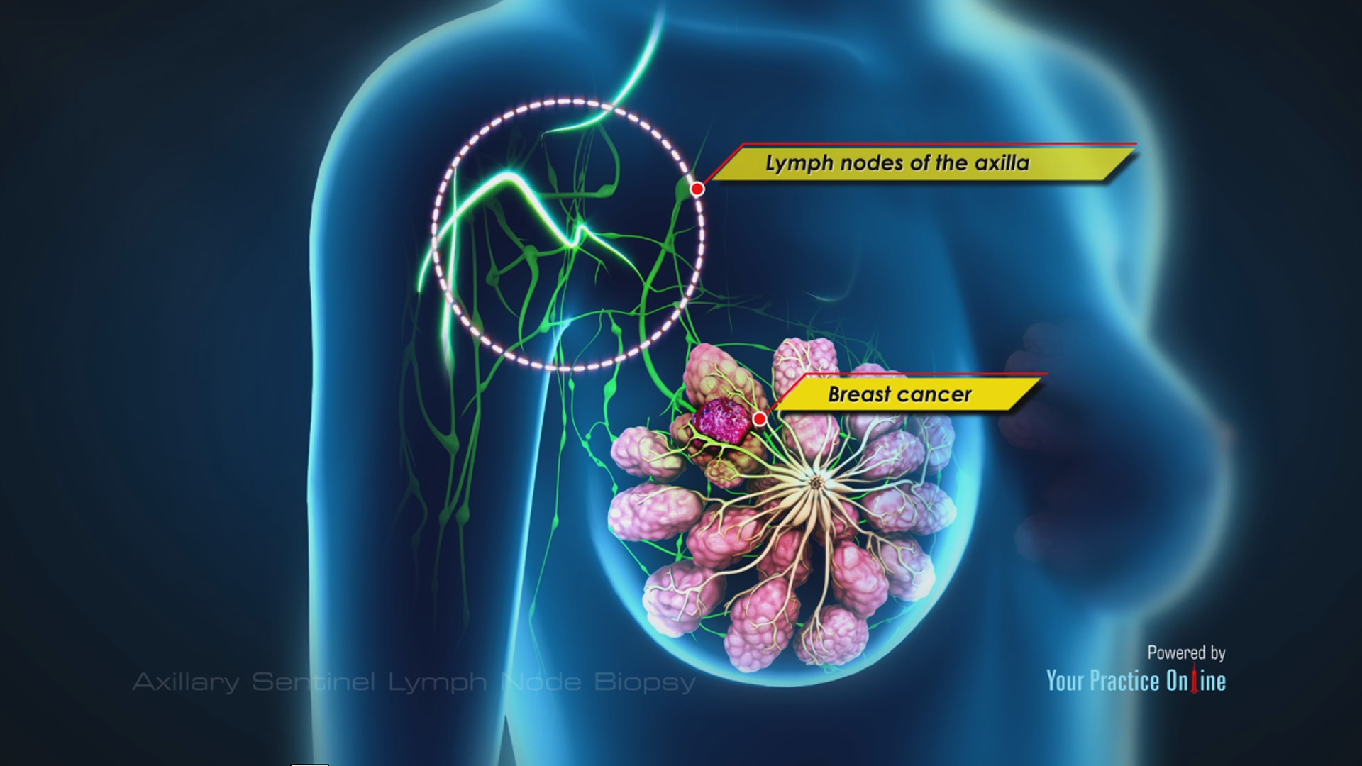 Axillary Sentinel Lymph Node Biopsy Video | Medical Video Library