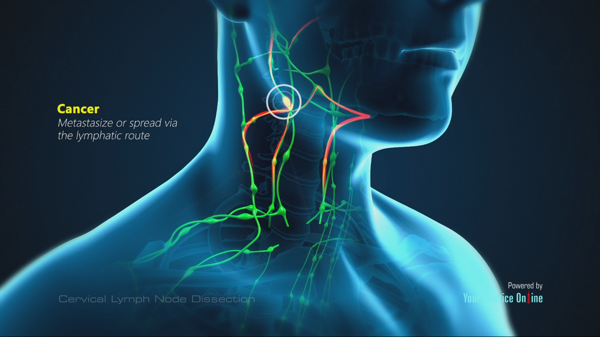 Lymph Node Lump On Neck