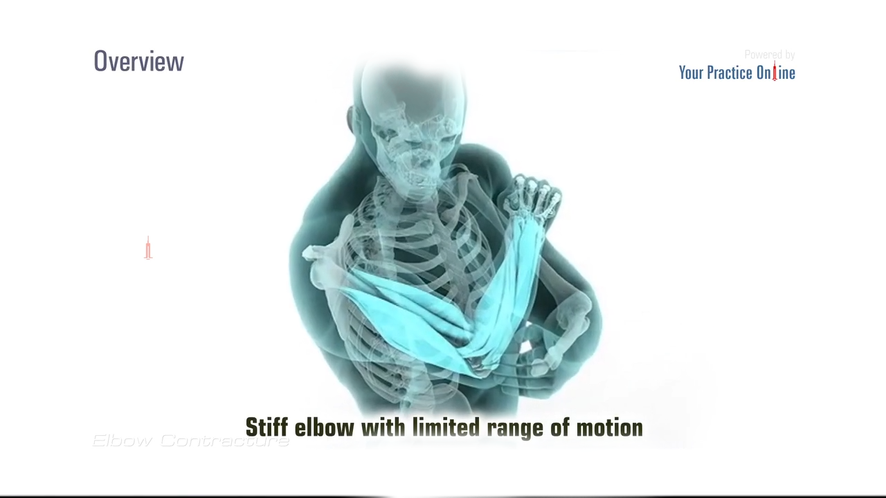 Elbow Contracture Video Medical Video Library