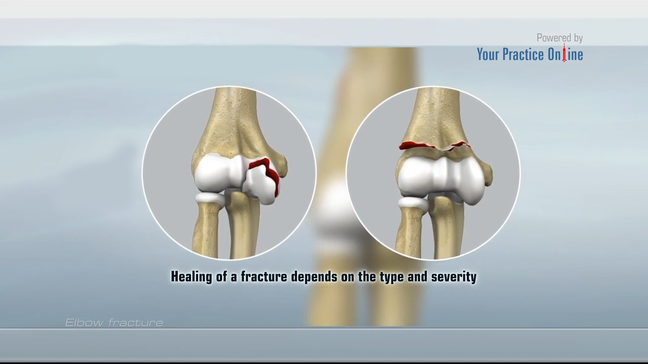 Elbow Fracture Video | Medical Video Library Elbow Fracture Video | Medical Video Library