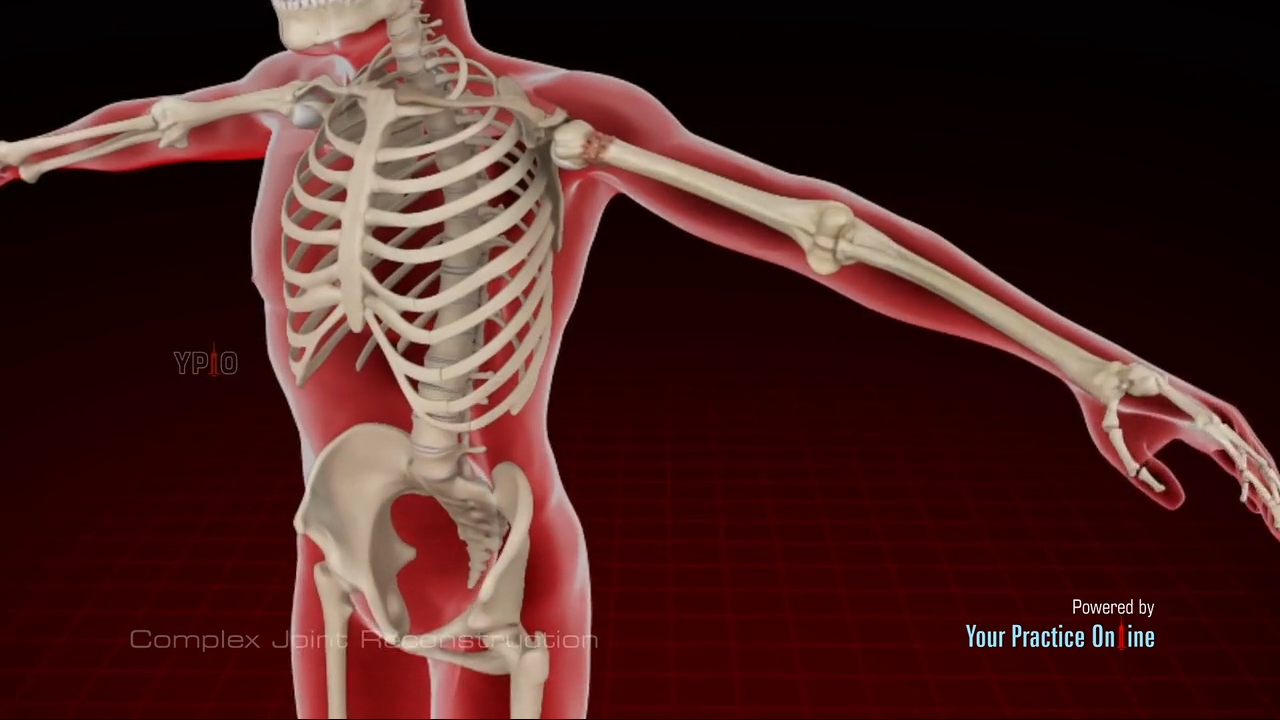 Complex Joint Reconstruction Video Medical Video Library