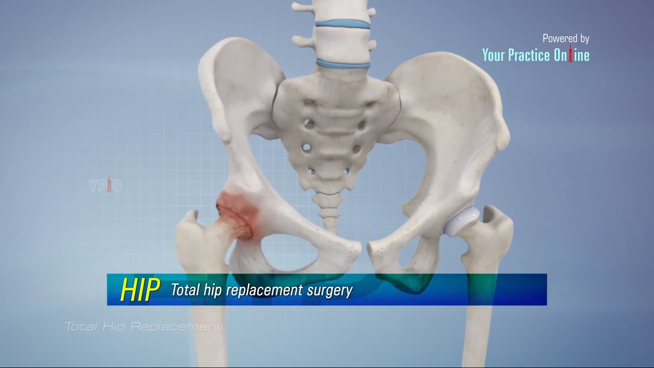 Total Hip Replacement Surgery Video, Hip Orthopaedics Videos