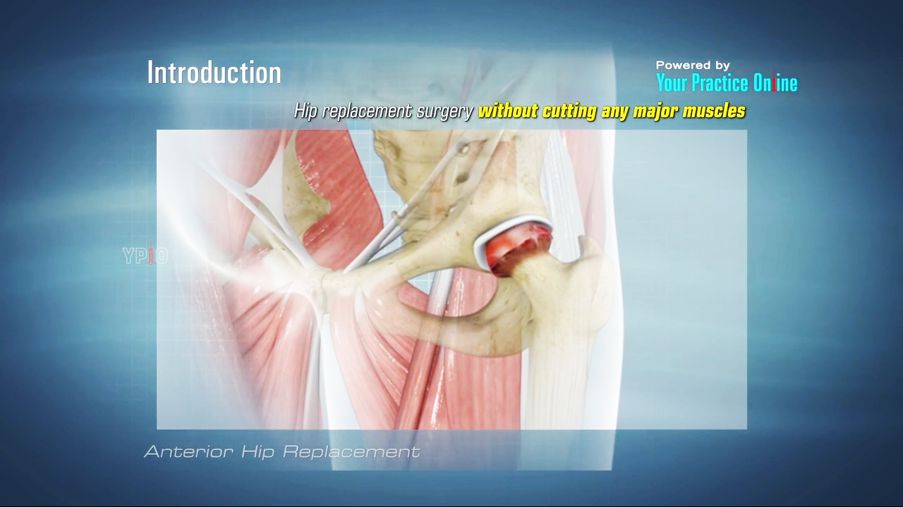 Anterior Hip Replacement Surgery Video | Hip Orthopaedics Videos | Ypo  Education