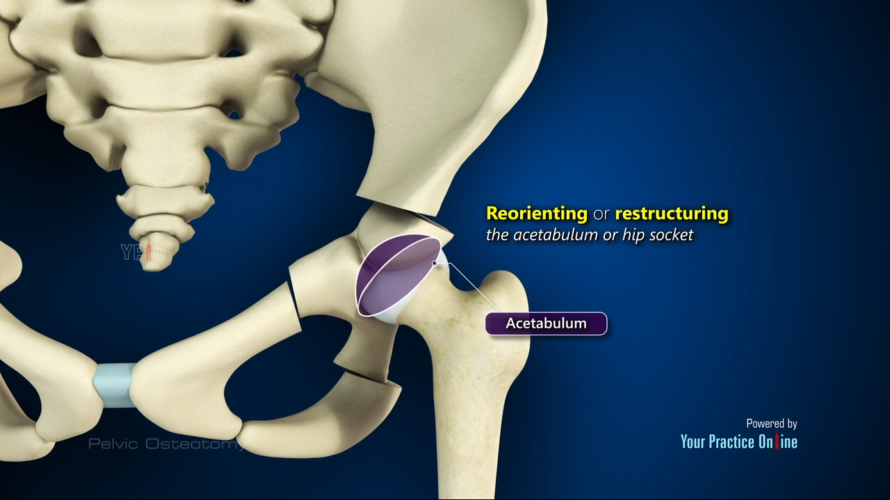Pelvic Osteotomy Video | Hip Surgery Videos | Your Practice Online