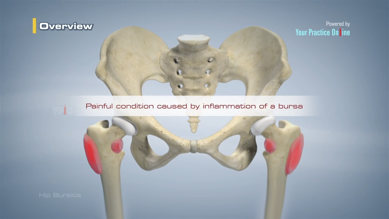 Hip Bursitis Video, Hip Orthopaedics Videos