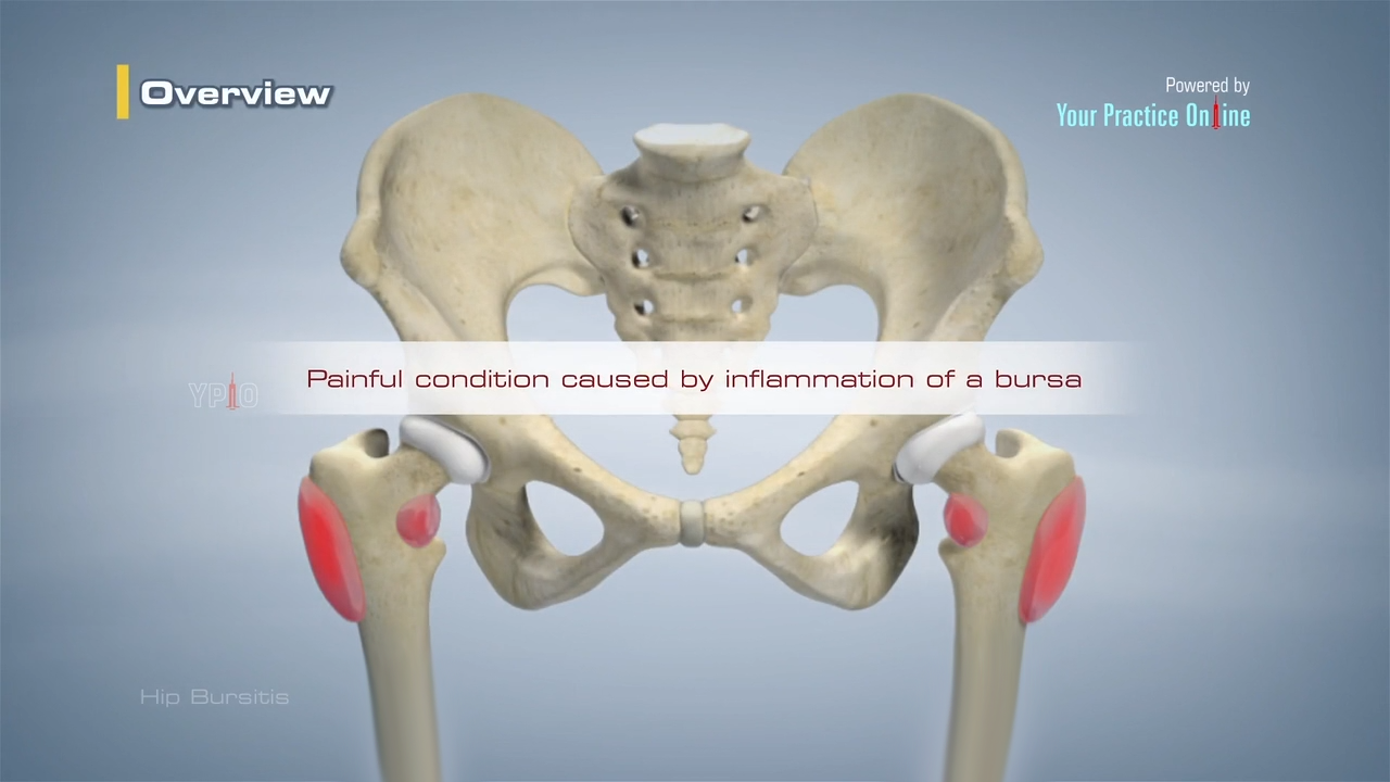 Have hip bursitis or lateral hip pain? Try this 