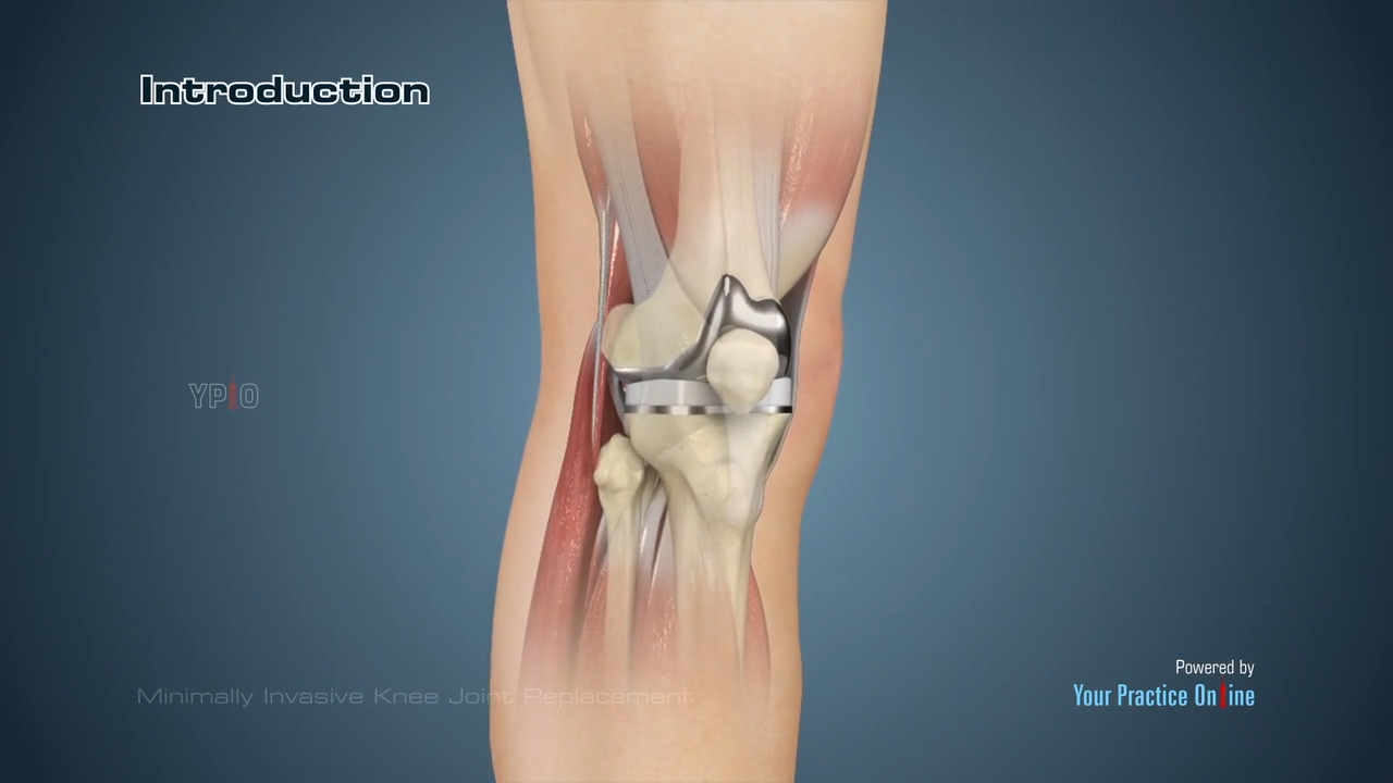 Minimally Invasive Knee Joint Replacement Video | Medical Video Library